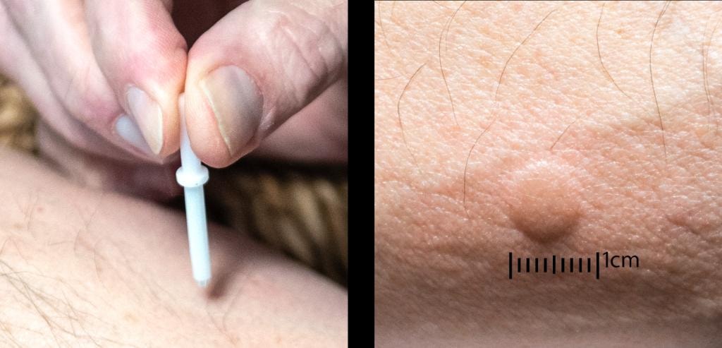 Bloodless Dx applicator and skin reaction